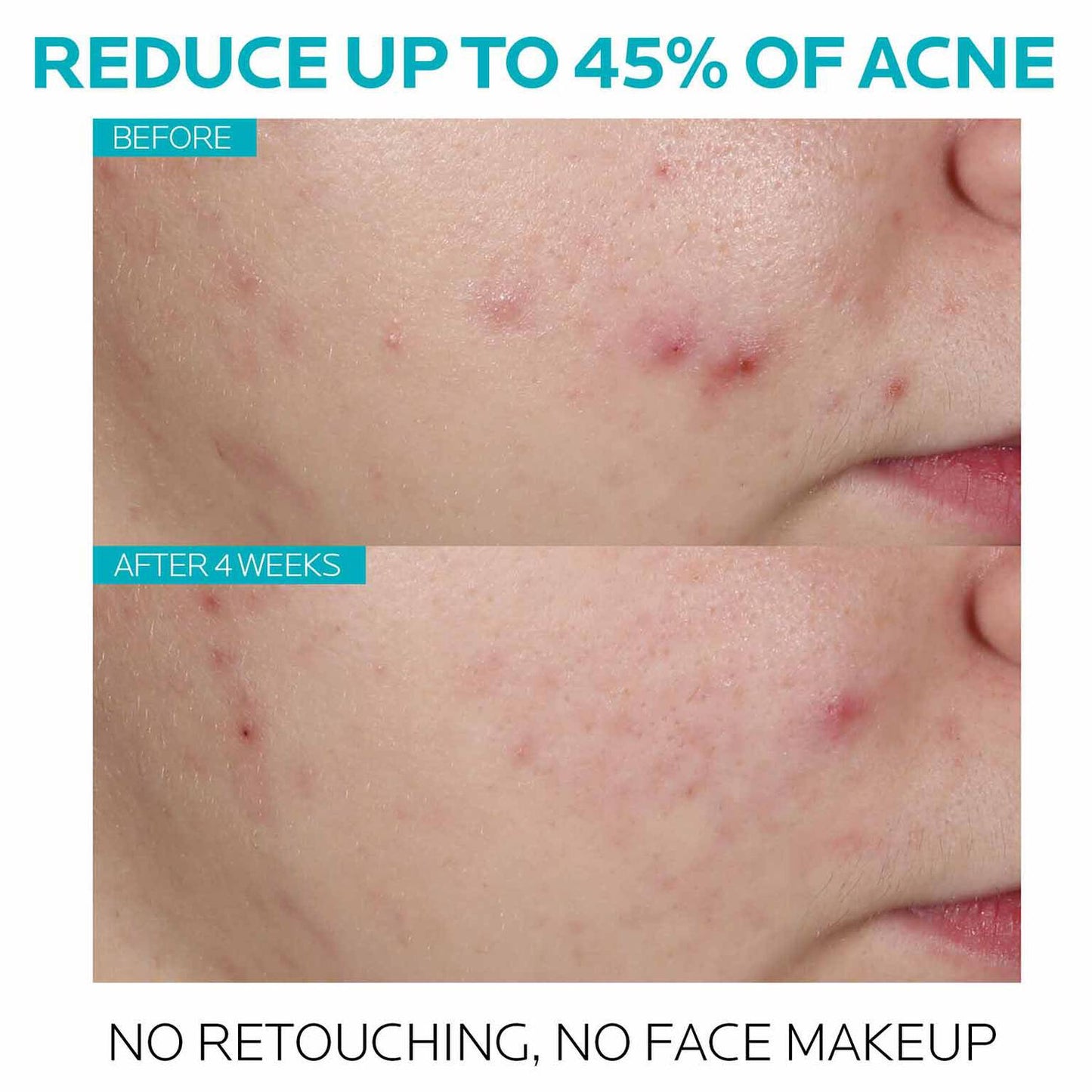 effaclar-salicylic-acid-acne-treatment-serum-g1 7_EffaclarSerum_After-45-days.jpg