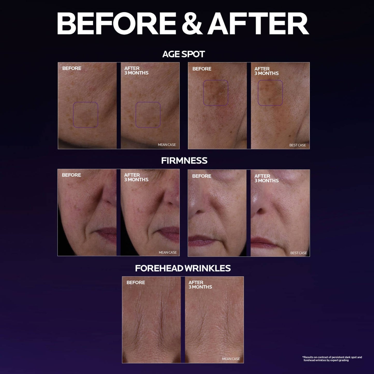 mela-b3-double-dose-discoloration-treatment-with-melasyltm-b4 MelaB3_DD_BTF_BeforeAfter_1500x1500_5.jpg