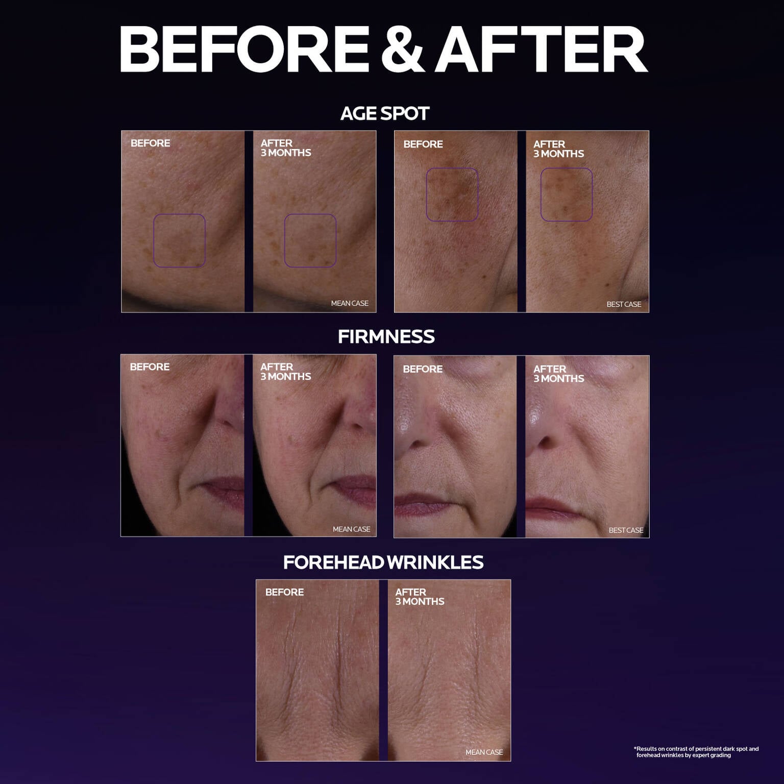 mela-b3-double-dose-discoloration-treatment-with-melasyltm-b4 MelaB3_DD_BTF_BeforeAfter_1500x1500_5.jpg